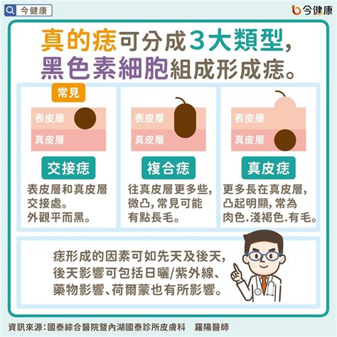 痣 凸起來|是痣or皮膚癌？醫「1張圖秒對照」 長這2部位最危險